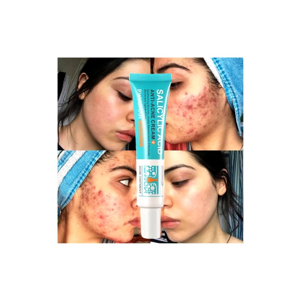 Salicylic Acid Anti-Acne Cream